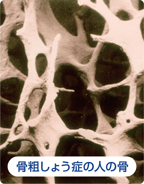 Poor bone